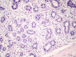 Раковая опухоль. Источник изображения: drmicrobe / фотобанк 123RF