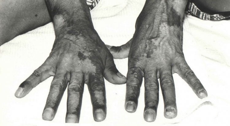 Радиационные ожоги на руках пострадавшего в аварии на Чернобыльской АЭС, 1986 год. Фото: ФМБЦ.