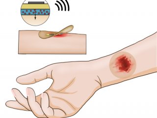 Беспроводной «умный» пластырь быстрее заживляет хронически раны на коже
