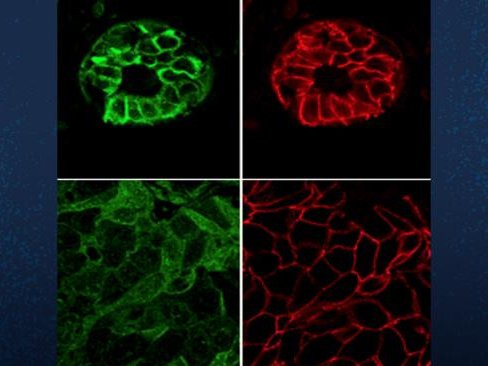 В здоровых тканях, показанных на двух верхних панелях, TYK2 (зеленый) находится на клеточной мембране и локализуется совместно с E-кадгерином (красный) — белком, помогающим поддерживать клеточную адгезию. Фото: UC San Diego Health Sciences / Zhimin Hu