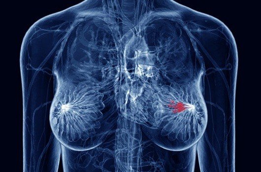 Рутинное тестирование двух лекарств привело к излечению рака груди у 11% участниц