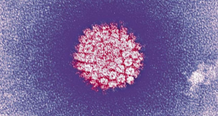 Тест на вирус папилломы человека лучше диагностирует рак шейки матки, чем ПАП-тест