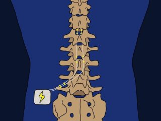Стимуляция спинного мозга полезна для одних пациентов, но не для других, и эффективность обычно оценивается в ходе испытания, которое длится от нескольких дней до двух недель перед постоянной имплантацией. Фото: UENO Kyohei / Kobe University