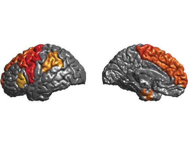 Крупнейшая база сканов мозга помогла выявить особенности анатомии эпилептиков