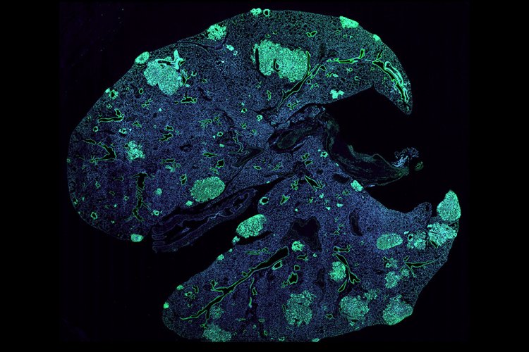 Легкое мыши с метастазами (зеленые) рака молочной железы.
