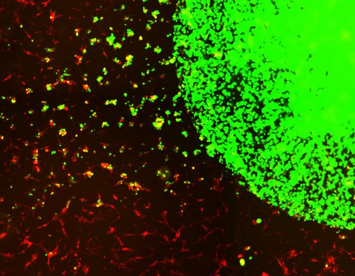 Ученые используют модифицированные стволовые клетки для лечения агрессивного рака мозга