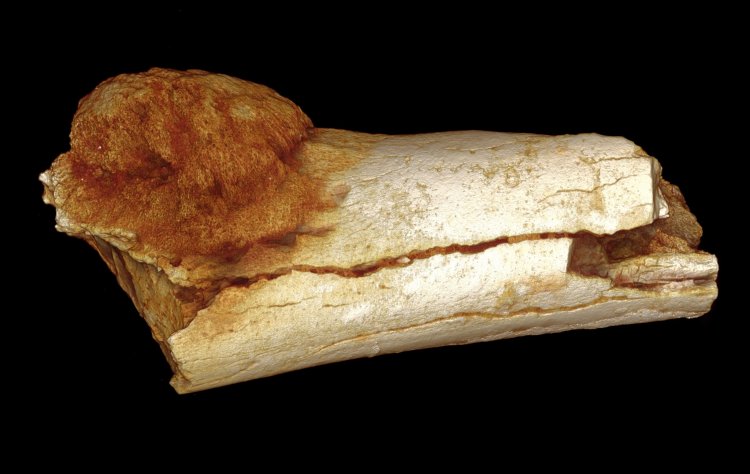 Наши предки страдали раком еще 1,7 млн лет назад