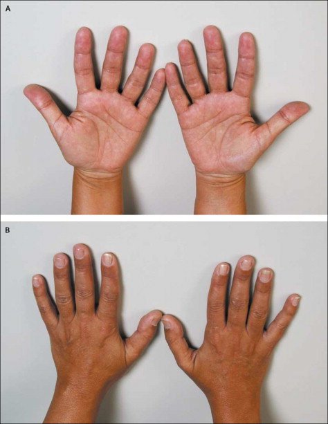 Бронзовая окраска кожи рук при надпочечниковой недостаточности 