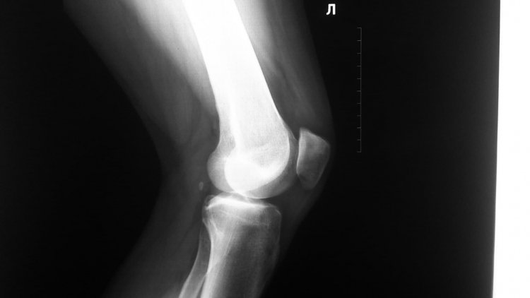 Коленный сустав на рентгене / Источник фото: Getty images