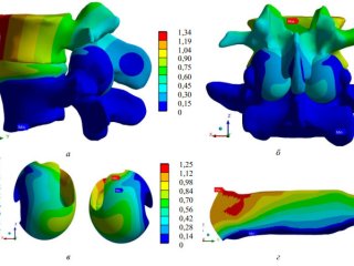 Поле суммарных перемещений. а – позвоночно-двигательный сегмент; б – позвоночнодвигательный сегмент; в – капсулы фасеточных суставов. Источник фото - пресс-служба ПНИПУ