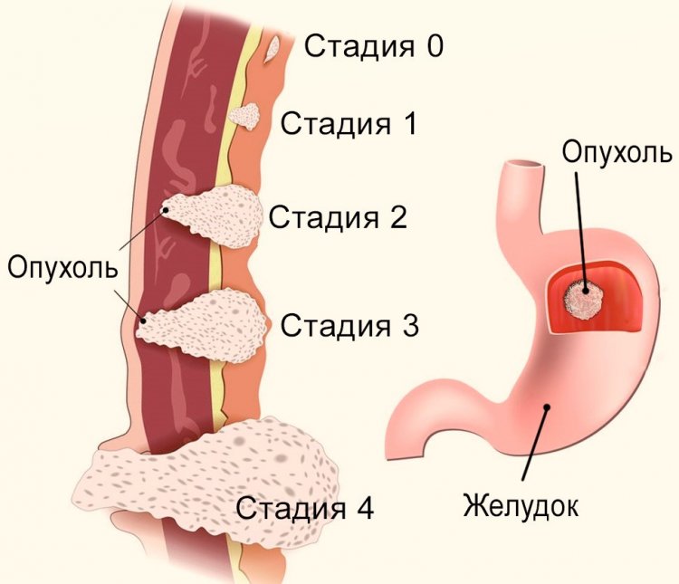 Развитие опухоли на примере желудка. Источник иллюстрации: rak03.ru