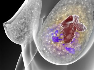 Найдены варианты генов, вызывающие рак груди