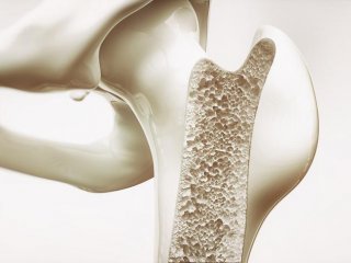 Ученые предложили новый способ повысить коррозионную стойкость костных имплантатов
