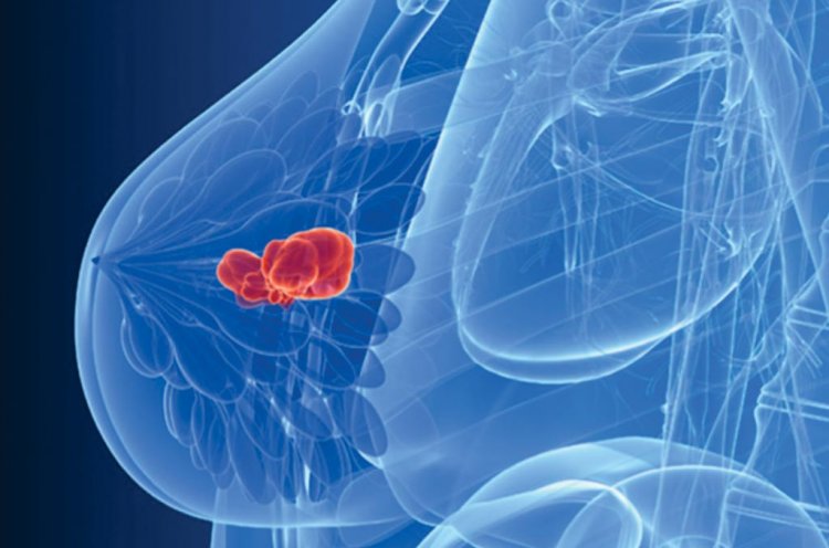 Иллюстрация рака молочной железы у женщины. Источник: globetechcdn.com