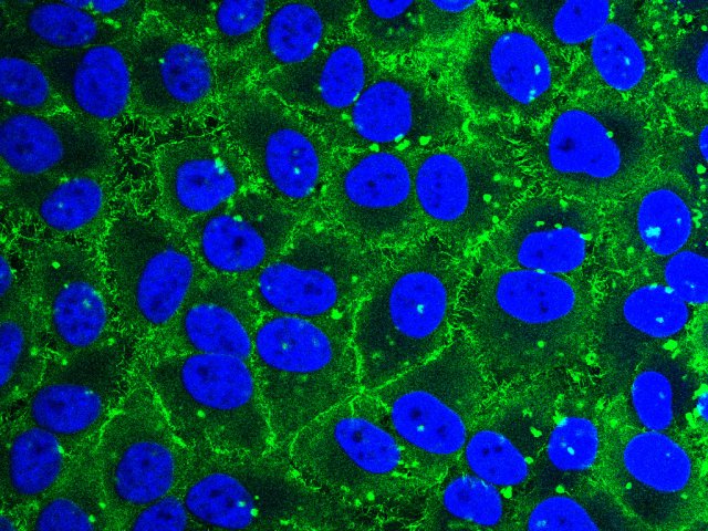 Рисунок 1. Монослой раковых клеток, выделенных из эпителия шейки матки