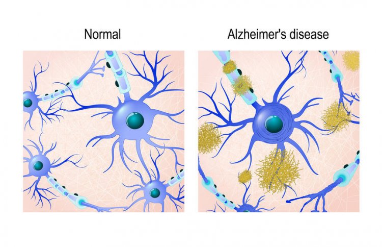 Утечка кальция в нейронах - ранний признак патологии Альцгеймера