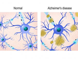 Утечка кальция в нейронах - ранний признак патологии Альцгеймера