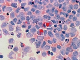 Рак. Источник: National Cancer Institute on Unsplash