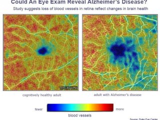 Офтальмолог сможет диагностировать болезнь Альцгеймера на ранней стадии