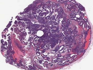 Опухоль молочной железы у мыши с нокаутом BPTF. У животных с низким уровнем этого белка было меньше метастазов, и они жили дольше, чем мыши с нормальным уровнем BPTF. Фото: dos Santos lab/CSHL