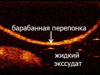 Оптический когерентный томограф для неинвазивного исследования среднего уха чел…