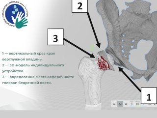 Трёхмерная модель тазобедренного сустава. Фото -пресс-служба НМИЦ им. Г.И. Турнера Минздрава России
