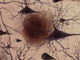 Легкие когнитивные нарушения предсказывают накопление амилоида и нейродегенерацию