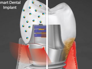 smart-dental-implant-600x400