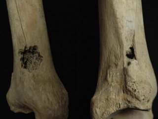 Древние перуанцы трепанировали не только черепа