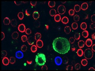 Красные клетки — это CD8-лимфоциты, «киллерные» Т-клетки, а синие клетки — это CD4-лимфоциты, «хелперные» Т-клетки. Меланома выделяет везикулы (маленькие зелёные точки), которые прикрепляются к CD8-клеткам. Фото: Tel Aviv University / Carmit Levy