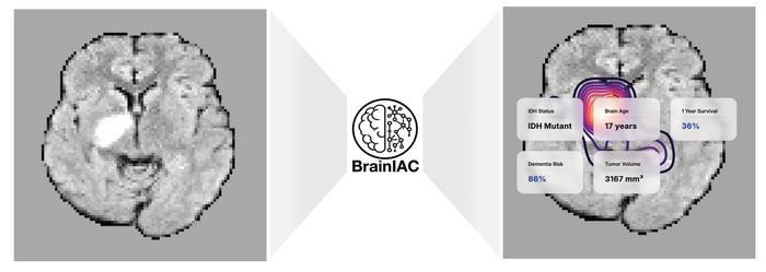 BrainIAC — это универсальная базовая модель для нейровизуализации, которая поддерживает различные клинические задачи, от прогнозирования молекулярных подтипов до оценки старения мозга и выживаемости. Фото: Divyanshu Tak, Mass General Brigham