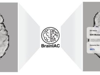 BrainIAC — это универсальная базовая модель для нейровизуализации, которая поддерживает различные клинические задачи, от прогнозирования молекулярных подтипов до оценки старения мозга и выживаемости. Фото: Divyanshu Tak, Mass General Brigham